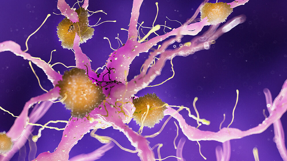 New Study Suggests THC and CBD Could Help Treat Agitation in Dementia Patients