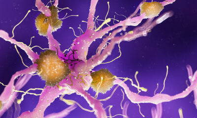 New Study Suggests THC and CBD Could Help Treat Agitation in Dementia Patients