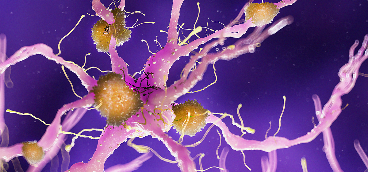 New Study Suggests THC and CBD Could Help Treat Agitation in Dementia Patients